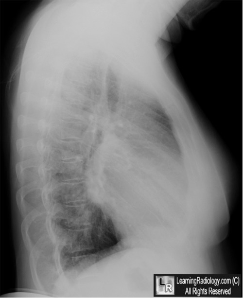 Stenosis Mitral Stenosis X Ray Findings